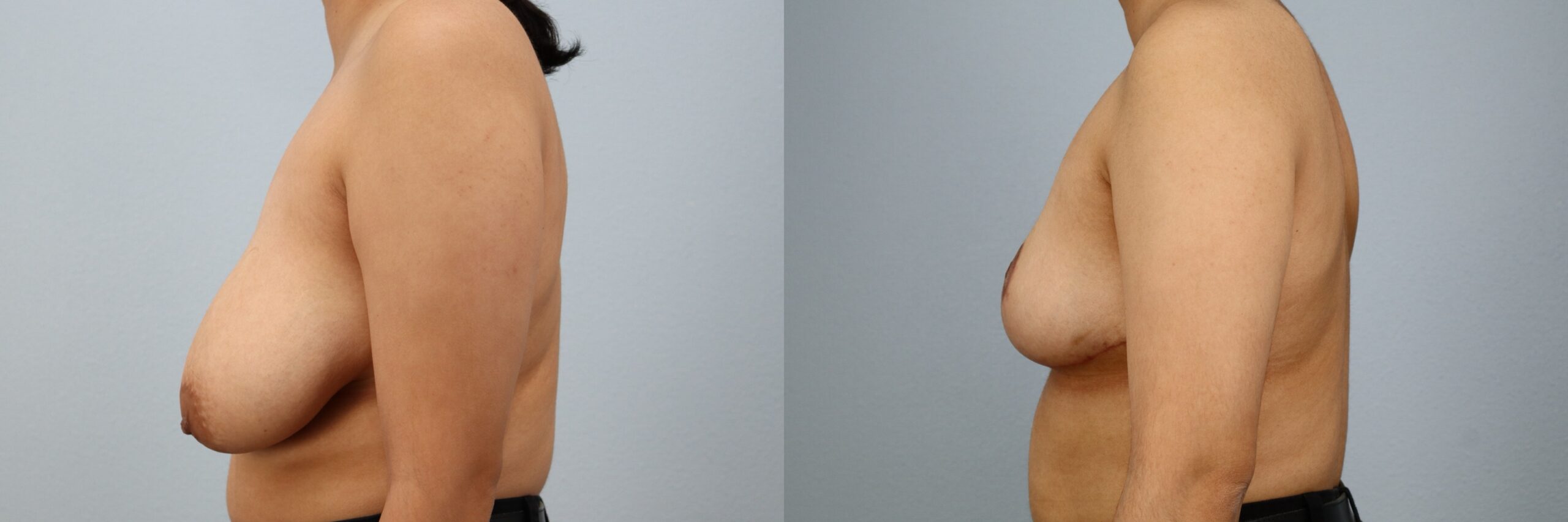 Before and after – Breast Reduction – Female patient, age 20-29 – Image 48
