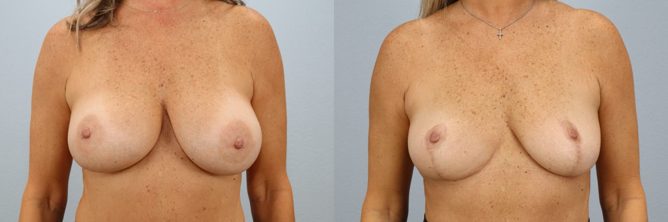 Before and after – Implant Removal – Female patient, age 50-59 – Image 5