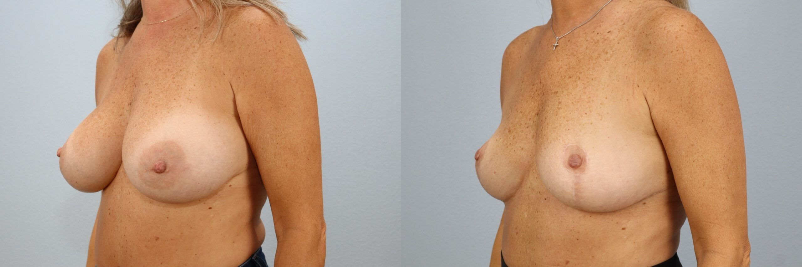 Before and after – Implant Removal – Female patient, age 50-59 – Image 6