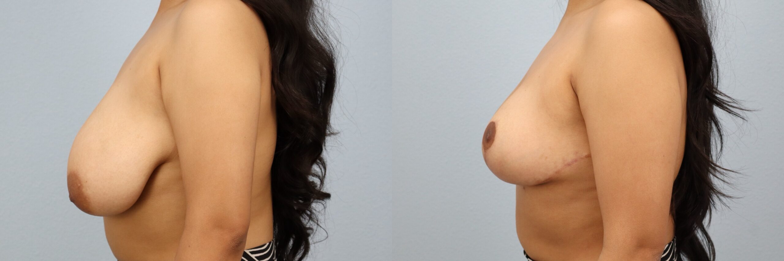 Before and after – Breast Reduction – Female patient, age 20-29 – Image 45