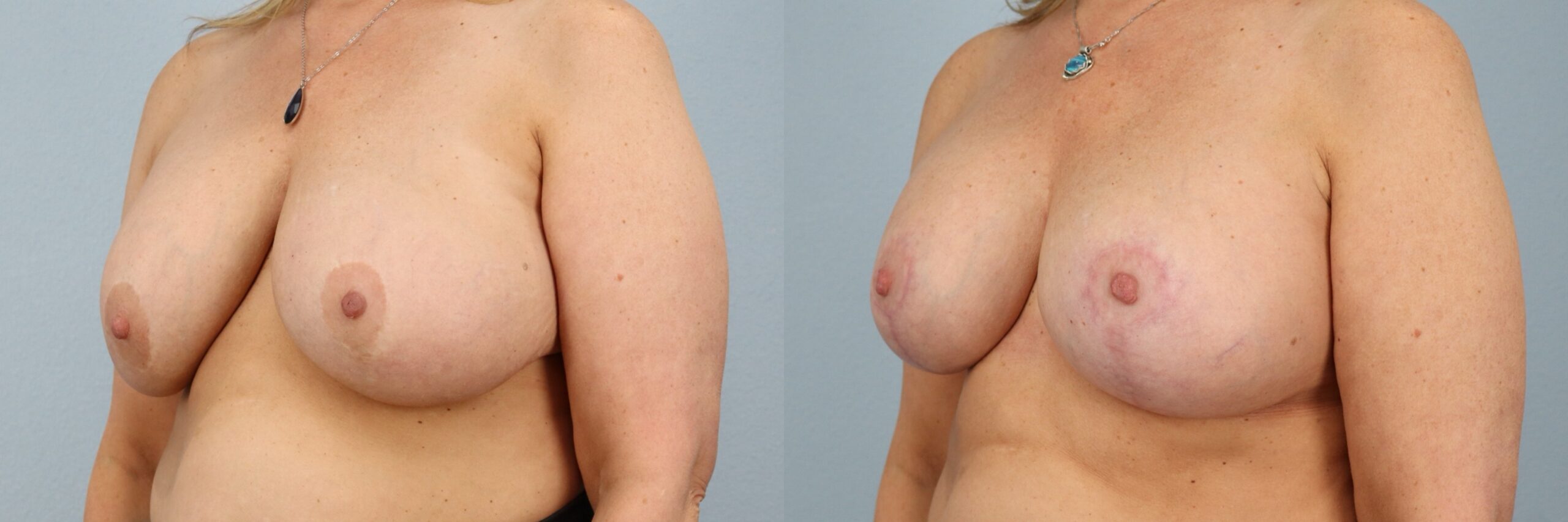 Before and after – Breast Revision – Female patient, age 50-59 – Image 32