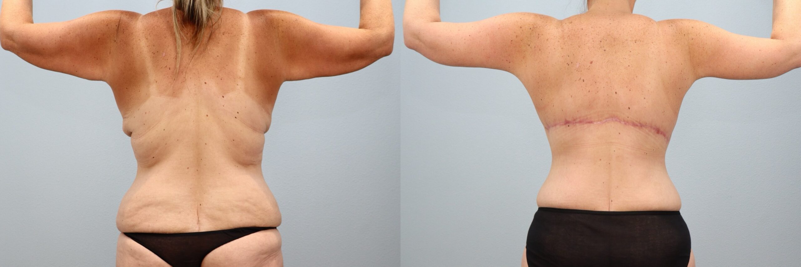 Before and after – Bra Line Back Lift – Female patient, age 40-49 – Image 25