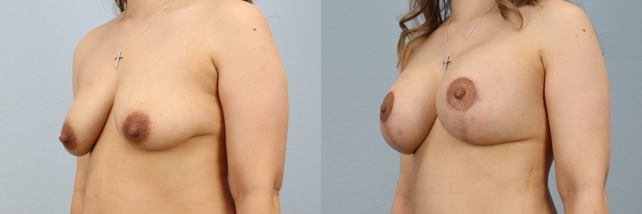 Before and after – Breast Surgery – Female patient, age 30-39 – Image 47