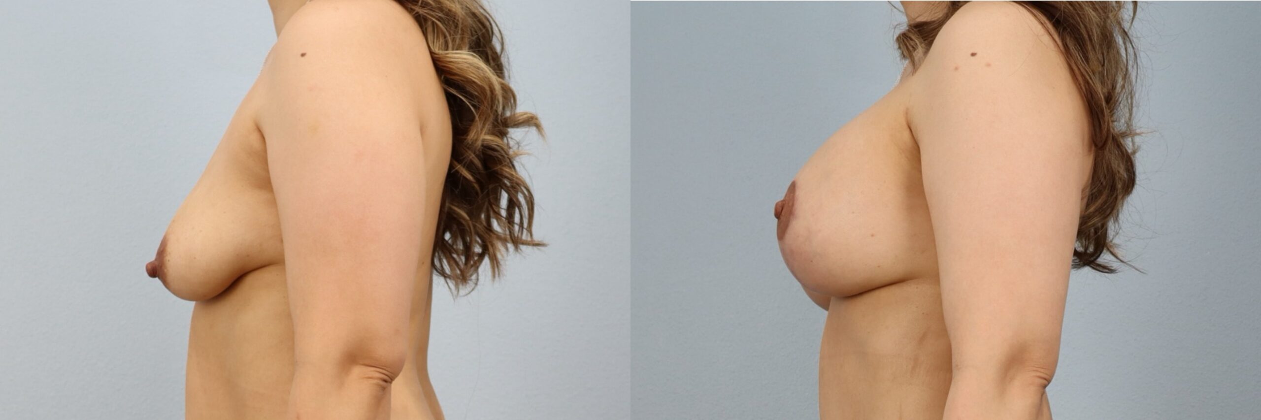Before and after – Breast Surgery – Female patient, age 30-39 – Image 48