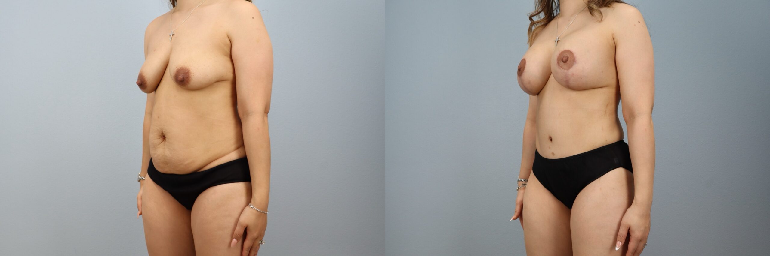 Before and after – Body Contouring – Female patient, age 30-39 – Image 17
