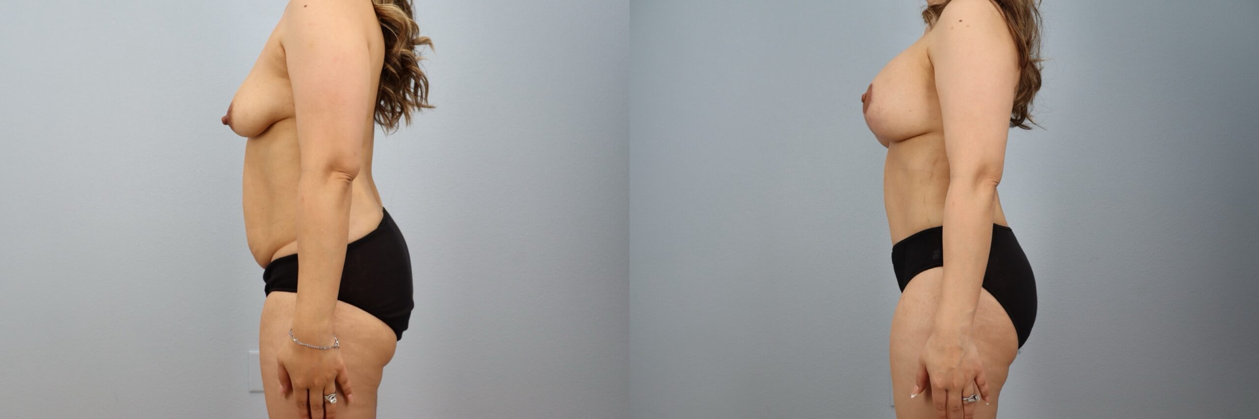 Before and after – Body Contouring – Female patient, age 30-39 – Image 18