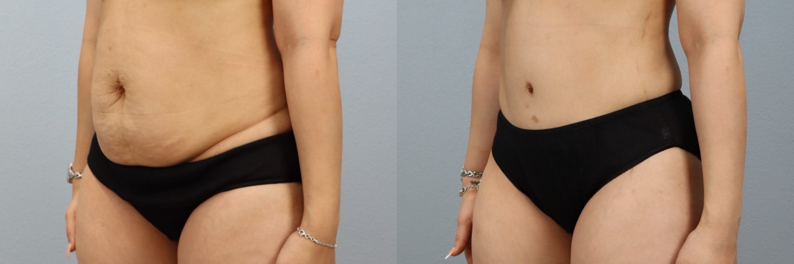 Before and after – Tummy Tuck – Female patient, age 30-39 – Image 44