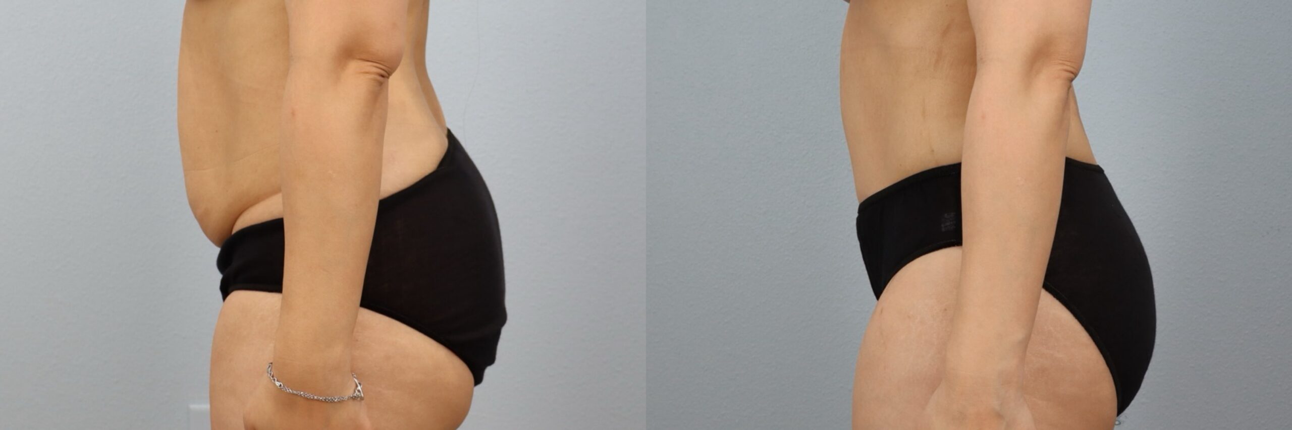 Before and after – Tummy Tuck – Female patient, age 30-39 – Image 45