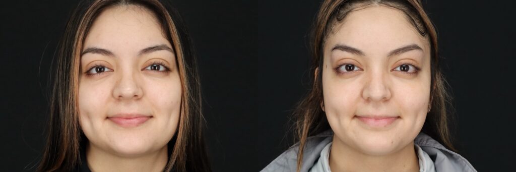 MA Botox Front Brow Raise