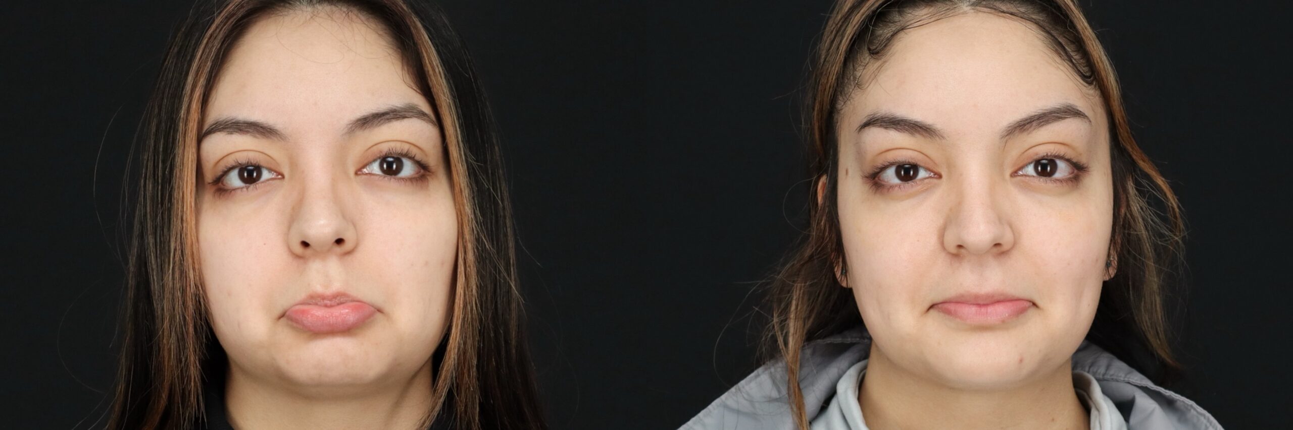 Before and after – Medi Spa – Female patient, age 20-29 – Image 18