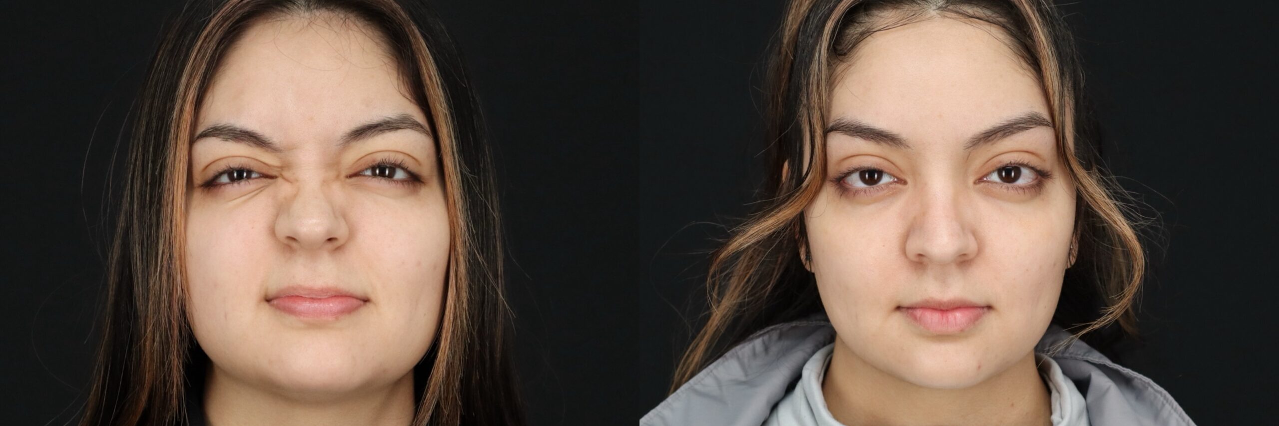 Before and after – Medi Spa – Female patient, age 20-29 – Image 17