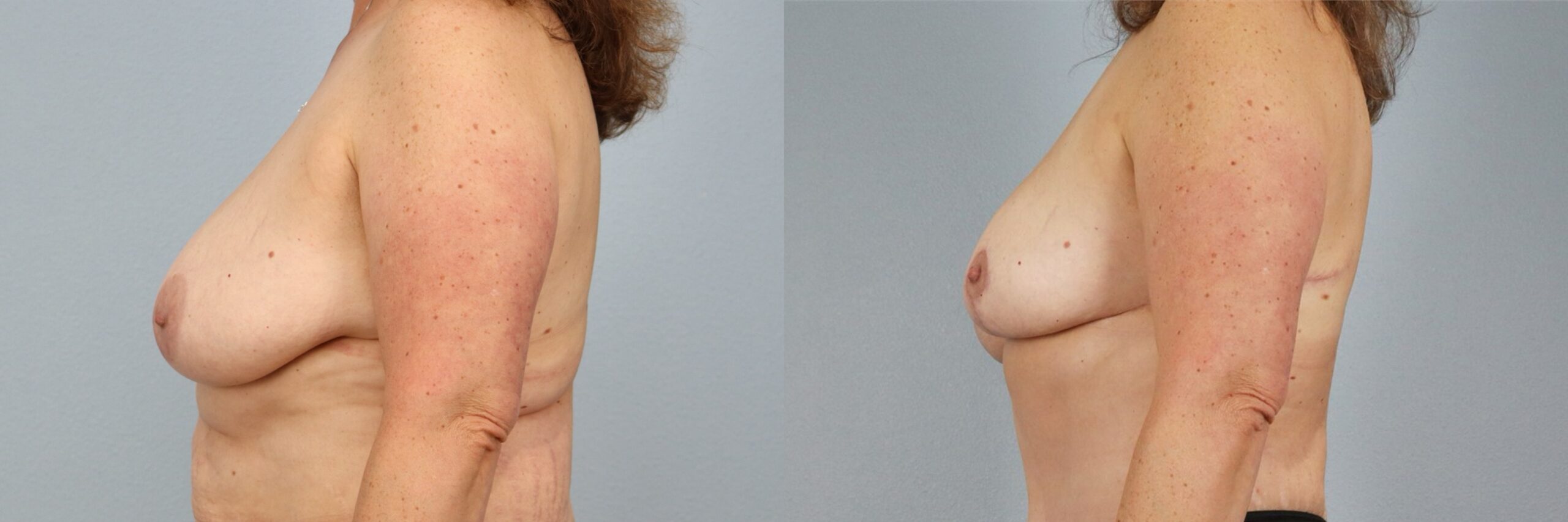 Before and after – Breast Reduction – Female patient, age 50-59 – Image 36