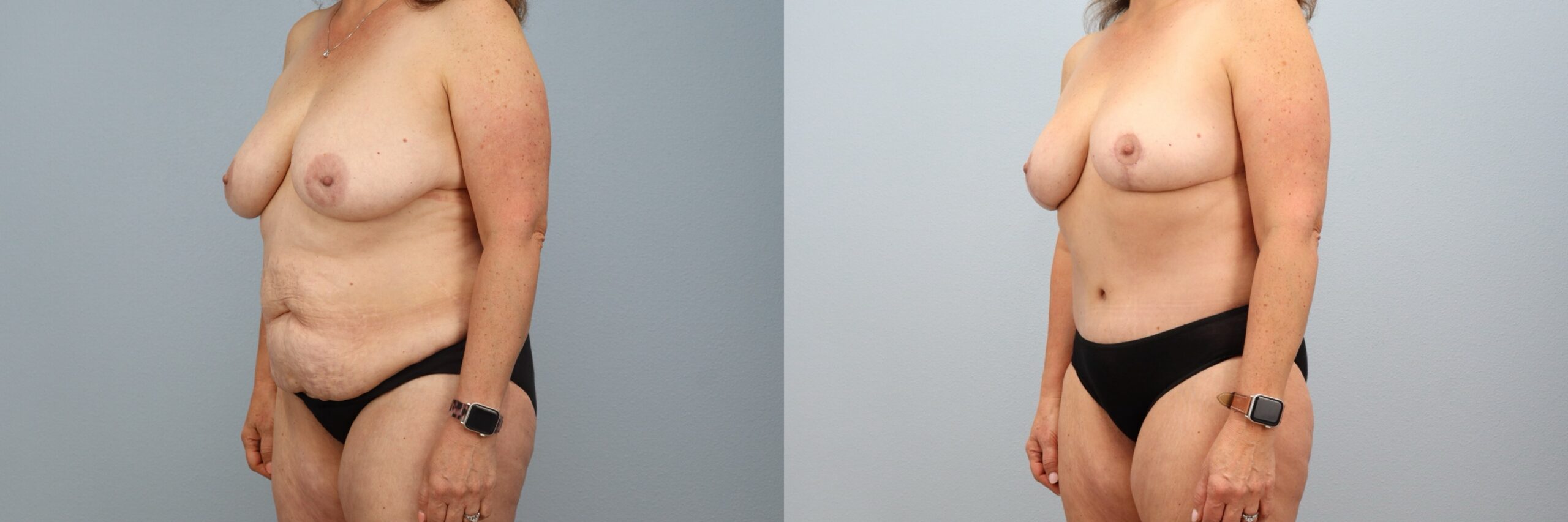 Before and after – Mommy Makeover – Female patient, age 50-59 – Image 59