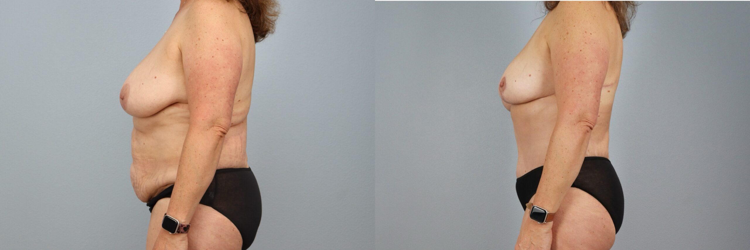 Before and after – Mommy Makeover – Female patient, age 50-59 – Image 60