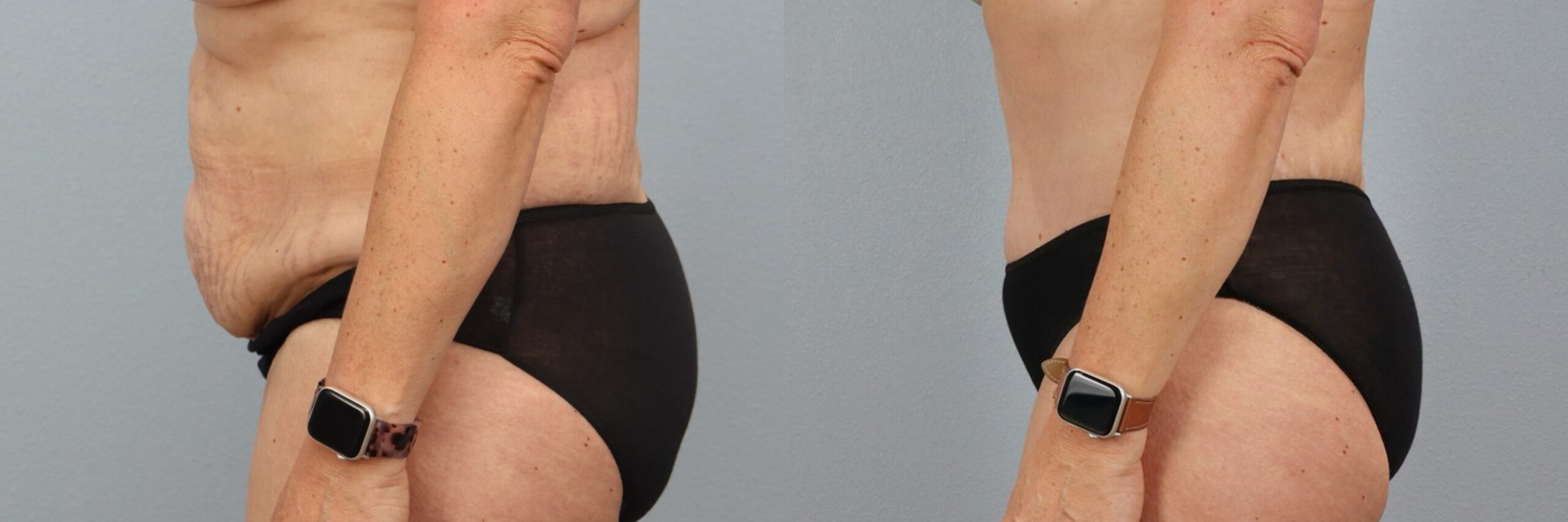 Before and after – Tummy Tuck – Female patient, age 50-59 – Image 9