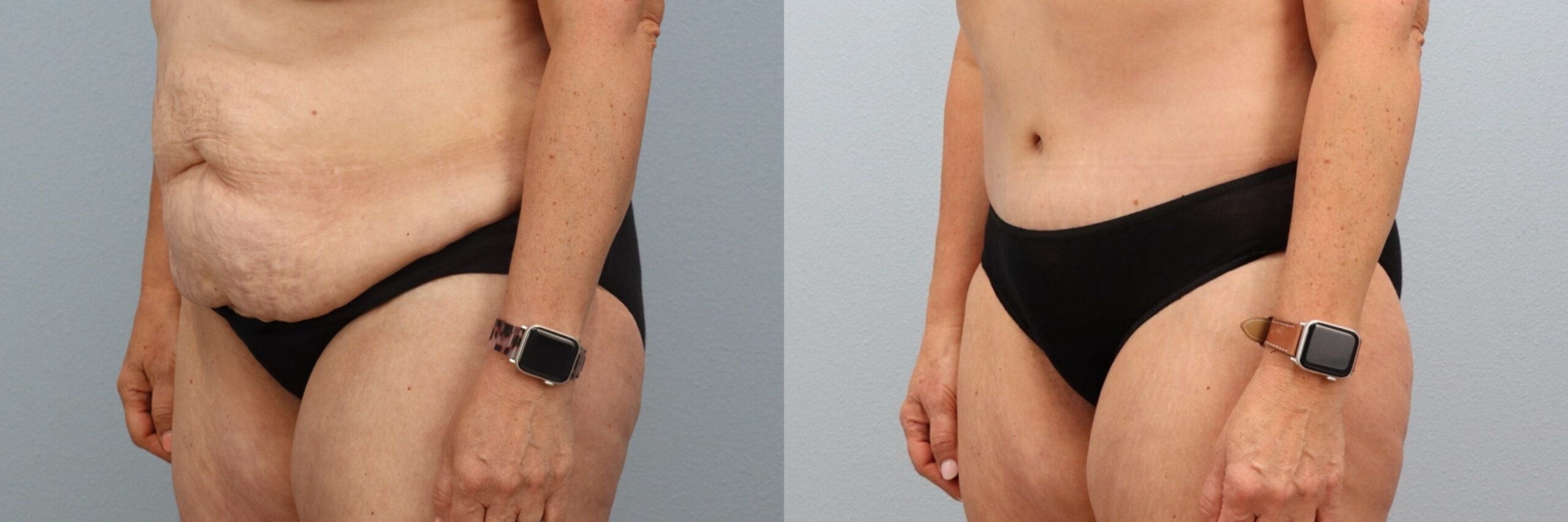 Before and after – Tummy Tuck – Female patient, age 50-59 – Image 8