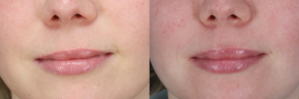 ML Botox Lip Flip Front Neutral