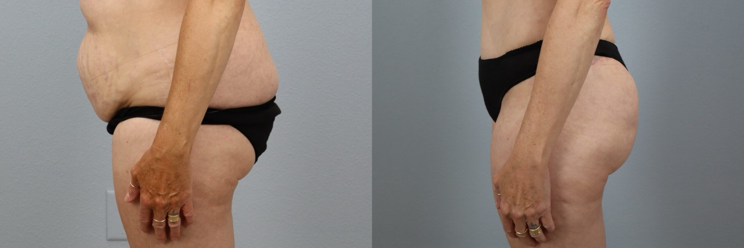 Before and after – Brazilian Butt Lift – Female patient, age 50-59 – Image 2