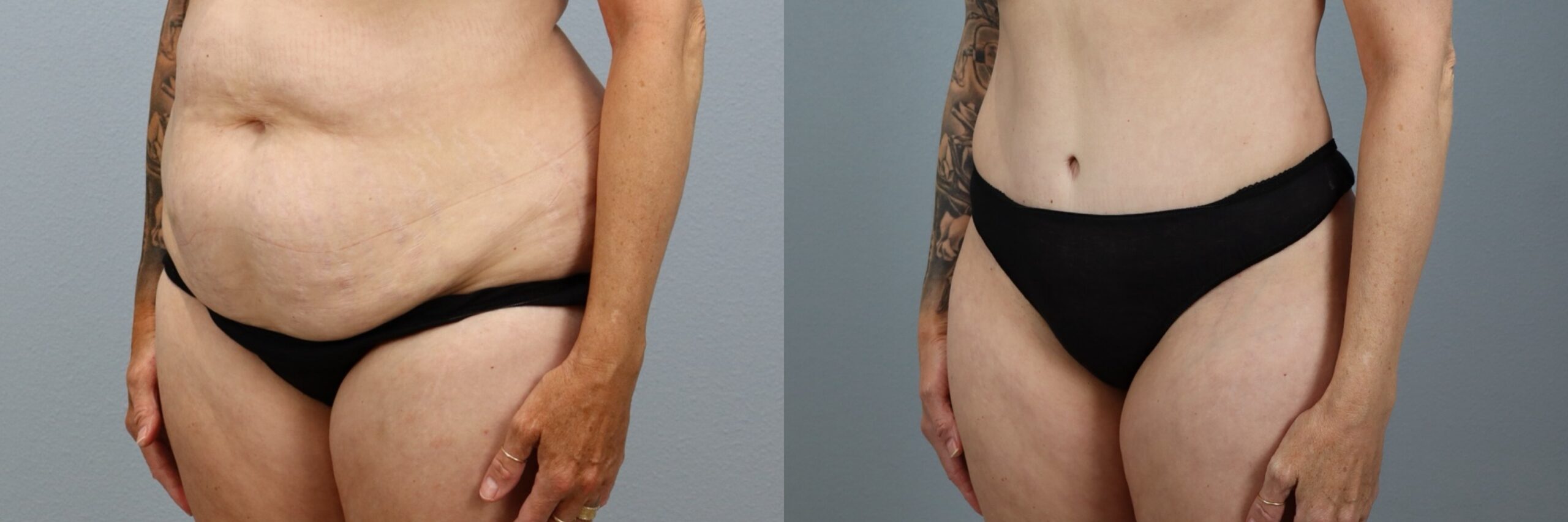 Before and after – Tummy Tuck – Female patient, age 50-59 – Image 35