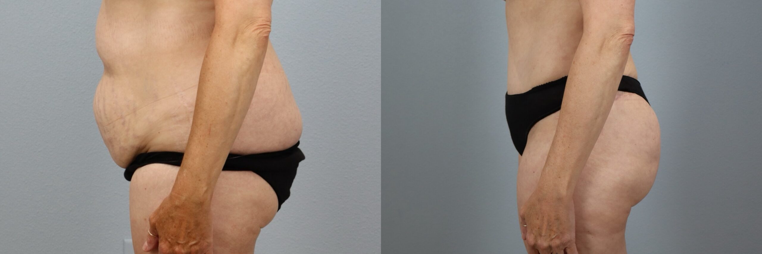 Before and after – Tummy Tuck – Female patient, age 50-59 – Image 36