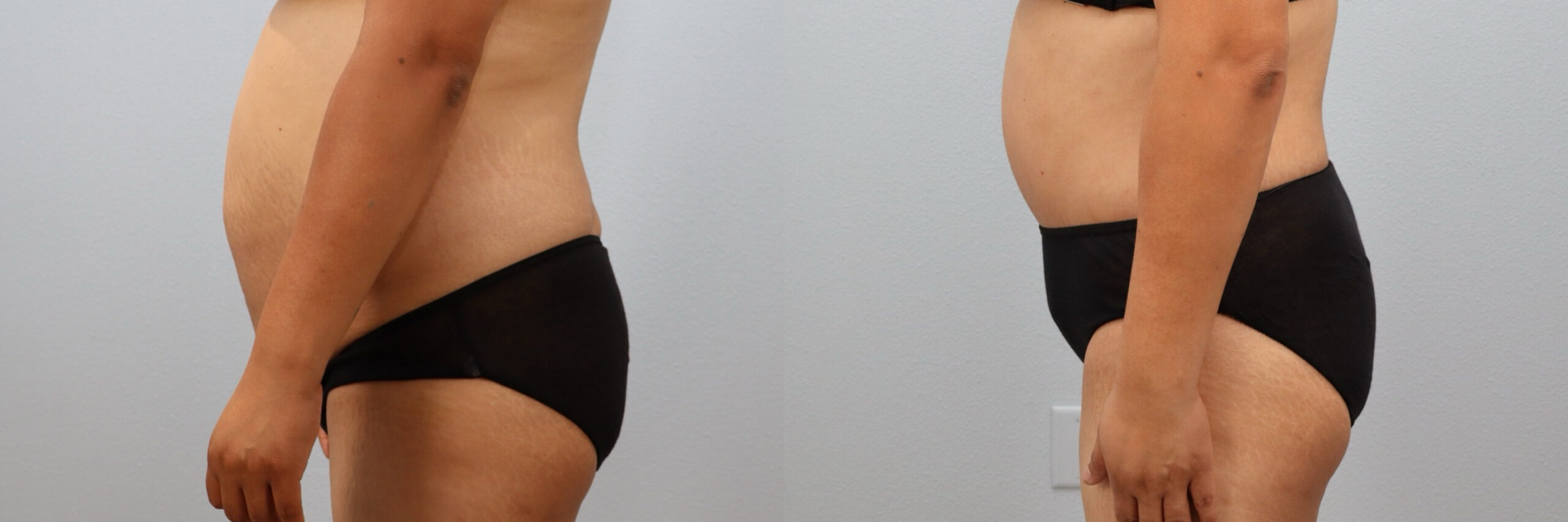 Before and after – Tummy Tuck – Female patient, age 30-39 – Image 12