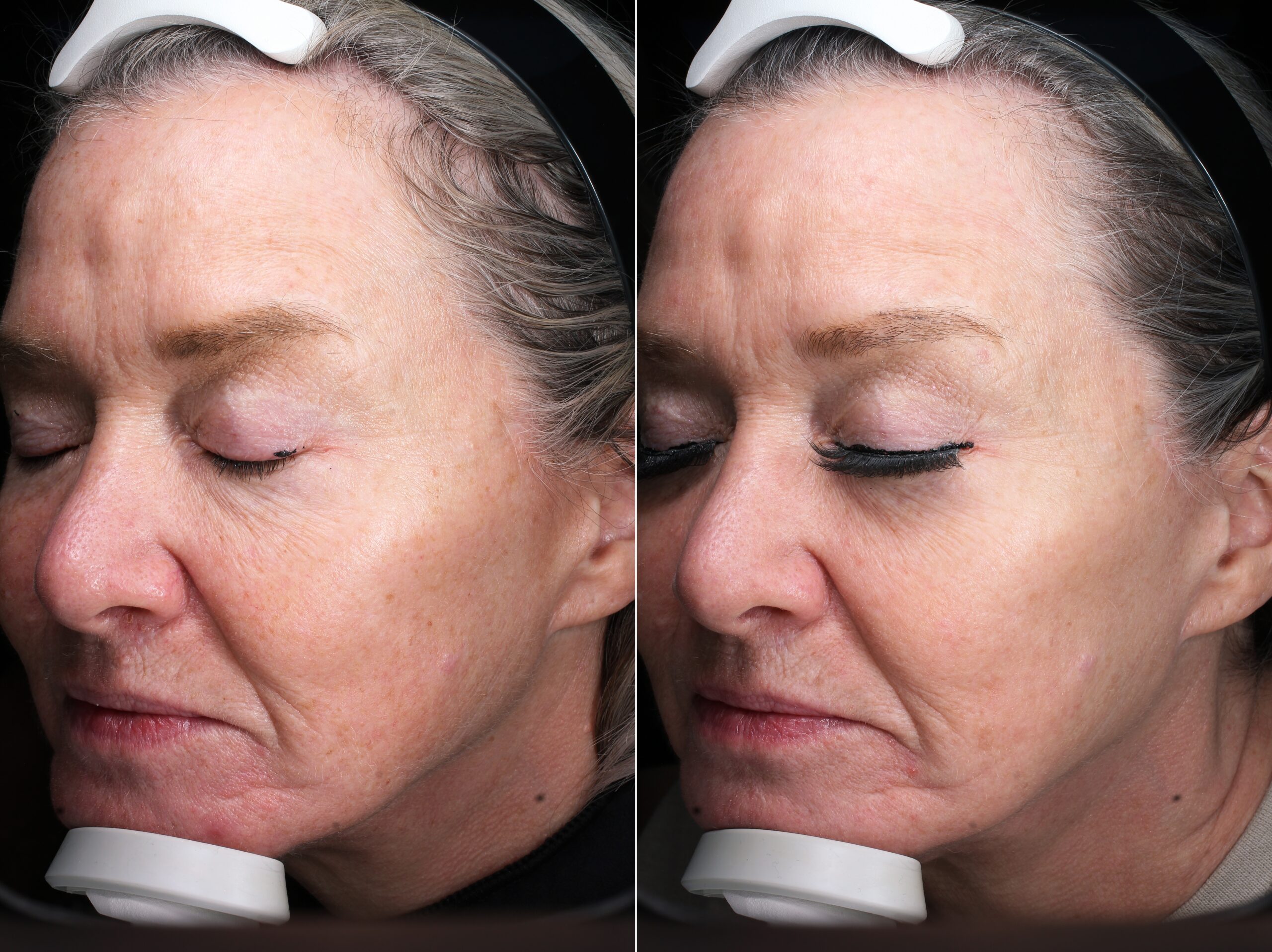 Before and after – Medi Spa – Female patient, age 50-59 – Image 43