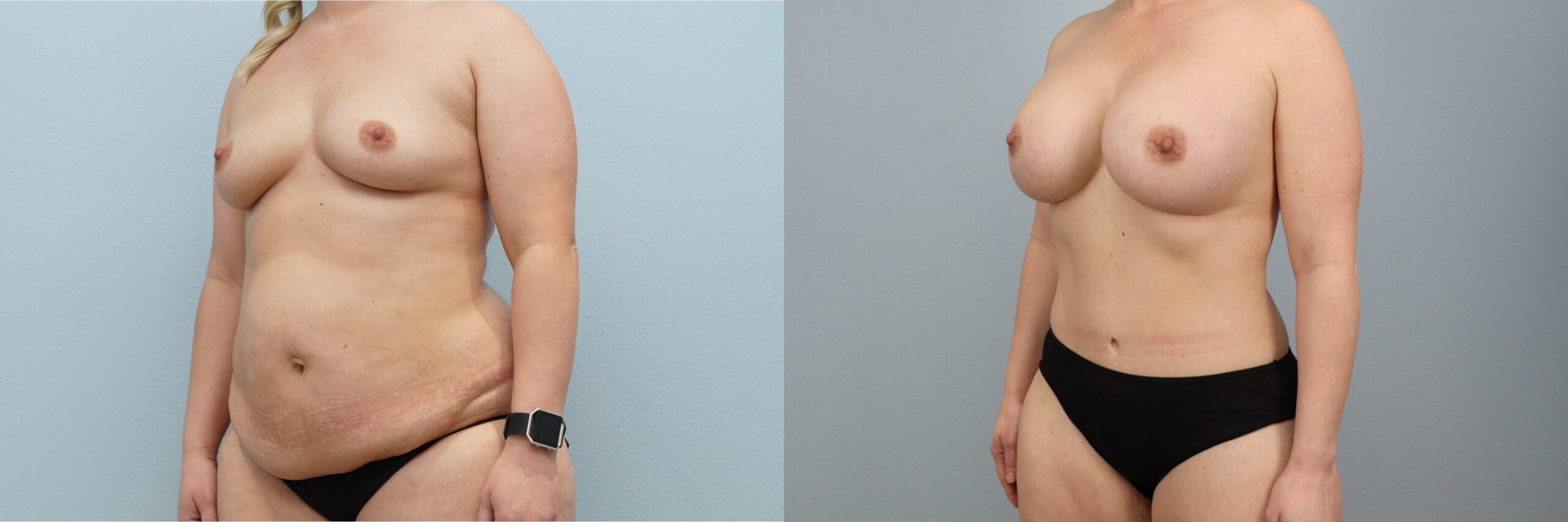Before and after – Body Contouring – Female patient, age 30-39 – Image 14