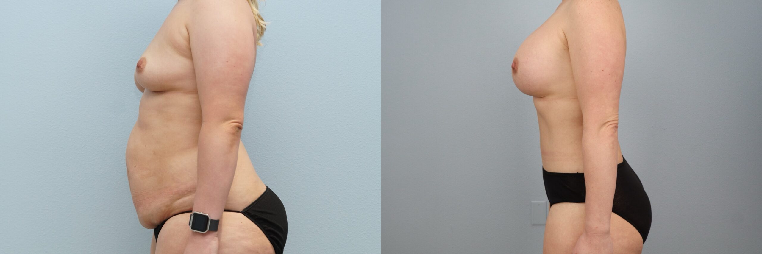 Before and after – Body Contouring – Female patient, age 30-39 – Image 15