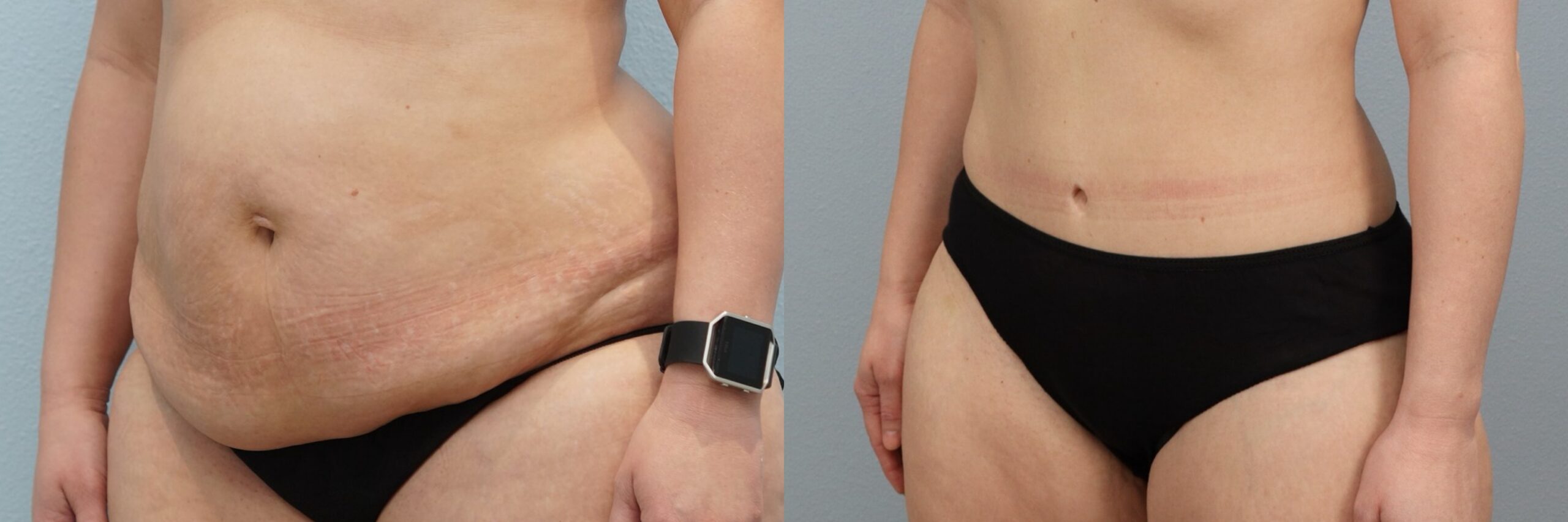 Before and after – Tummy Tuck – Female patient, age 30-39 – Image 41