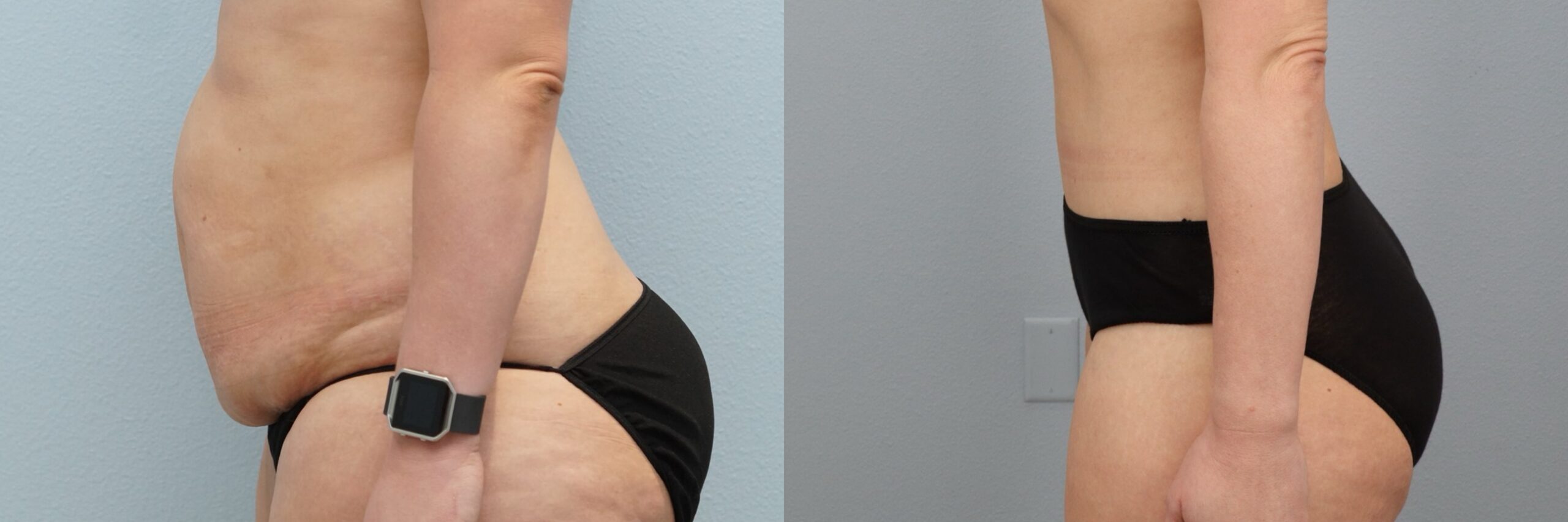 Before and after – Tummy Tuck – Female patient, age 30-39 – Image 42