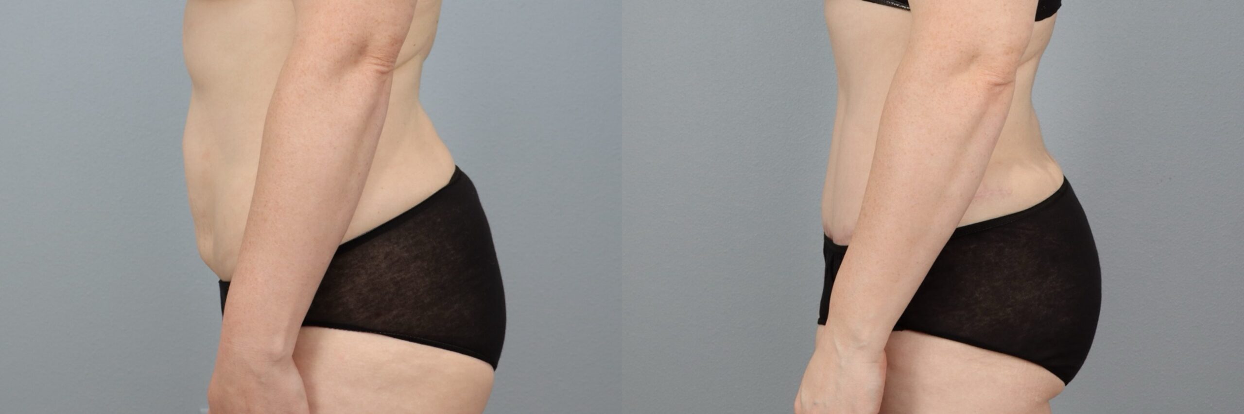 Before and after – Tummy Tuck – Female patient, age 30-39 – Image 39