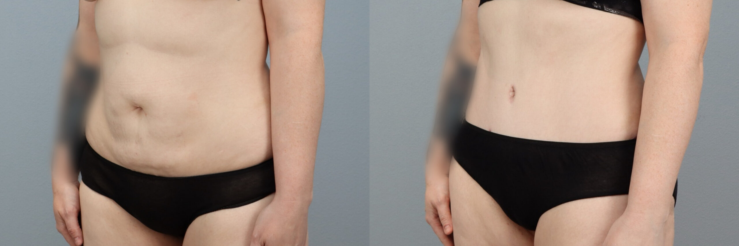 Before and after – Tummy Tuck – Female patient, age 30-39 – Image 38