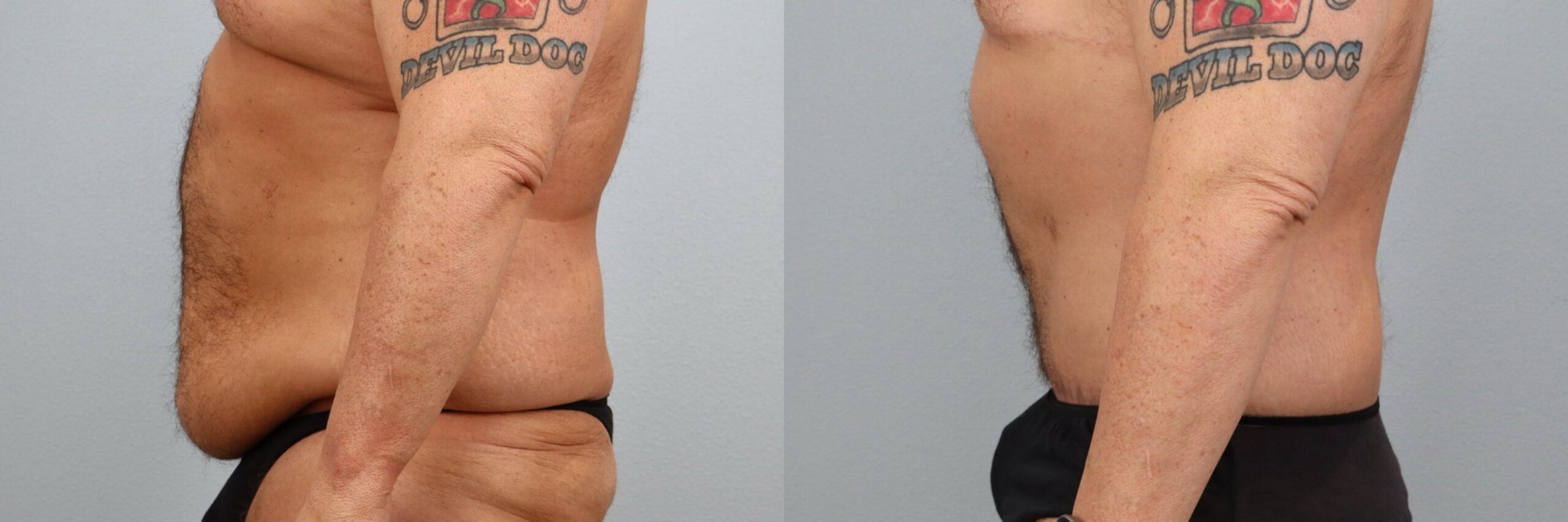 Before and after – Male Surgery – Male patient, age 50-59 – Image 15