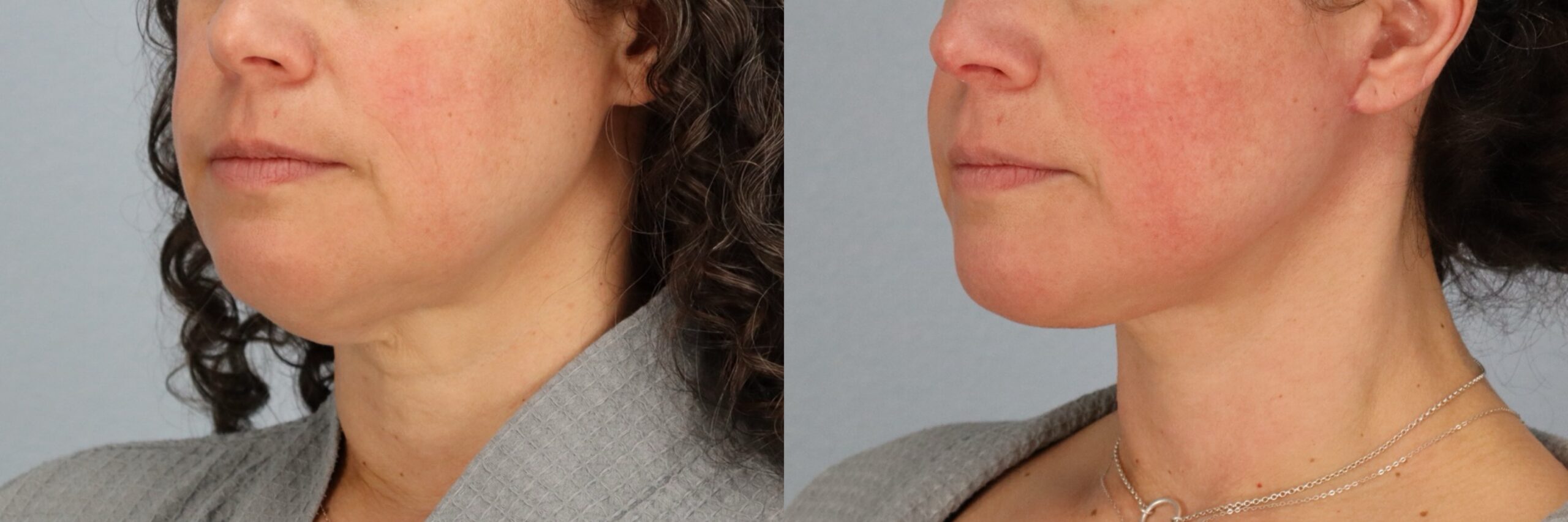 Before and after – Neck Lift – Female patient, age 40-49 – Image 26