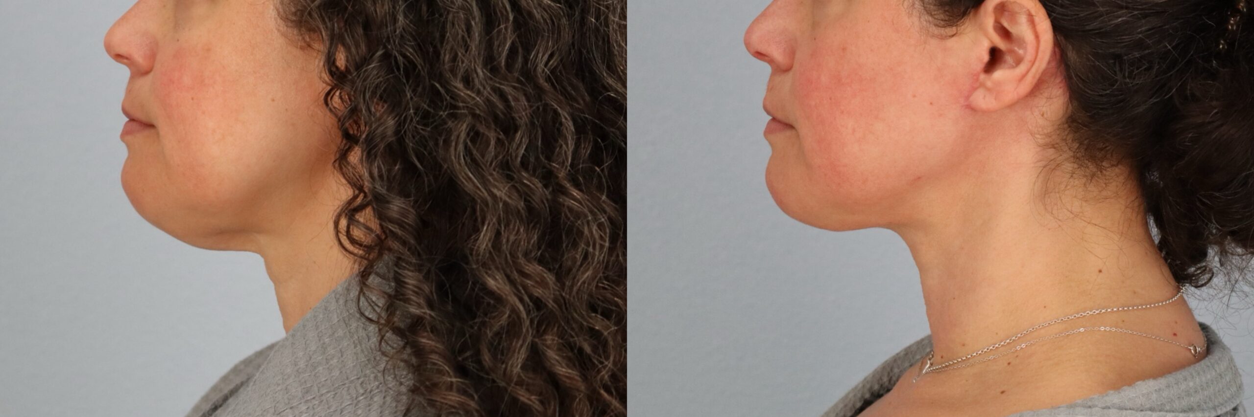 Before and after – Neck Lift – Female patient, age 40-49 – Image 27