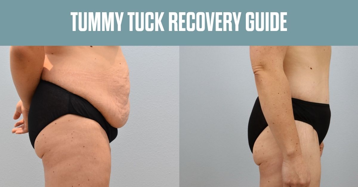 tummy tuck recovery guide