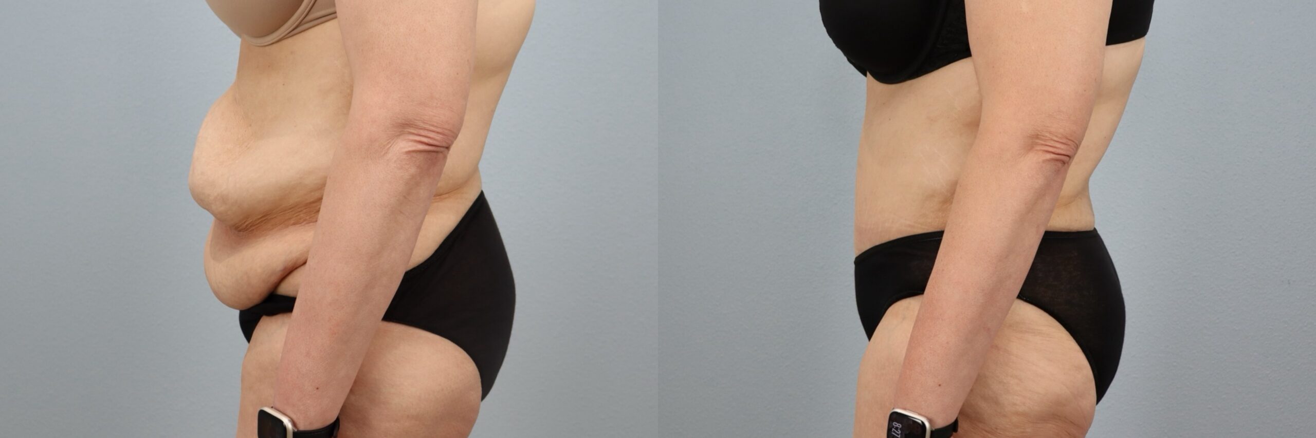Before and after – Tummy Tuck – Female patient, age 50-59 – Image 54