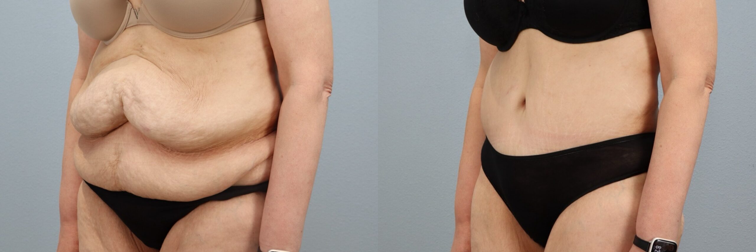 Before and after – Tummy Tuck – Female patient, age 50-59 – Image 53