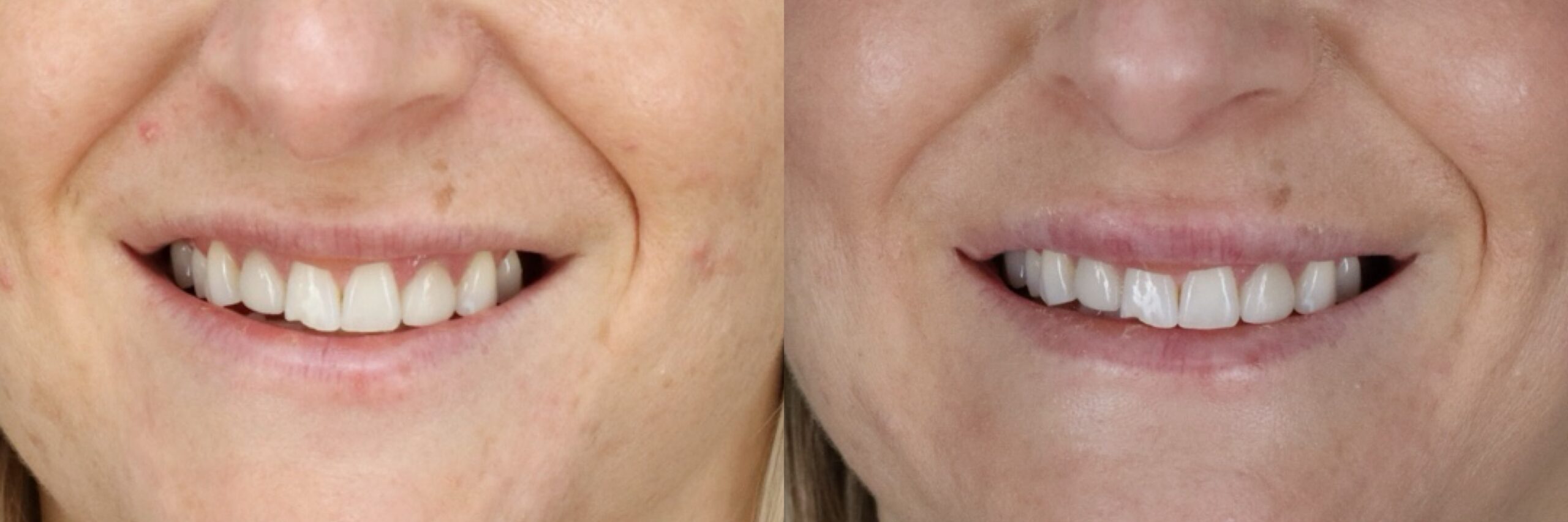 Before and after – Filler – Female patient, age 40-49 – Image 8