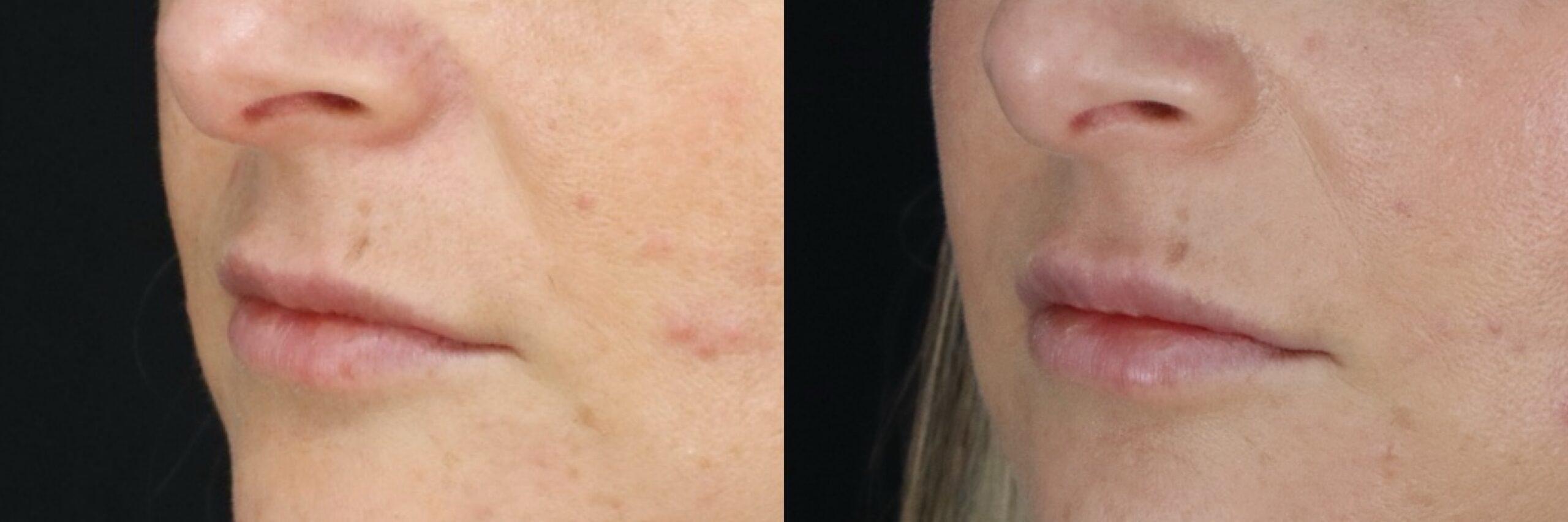 Before and after – Filler – Female patient, age 40-49 – Image 9