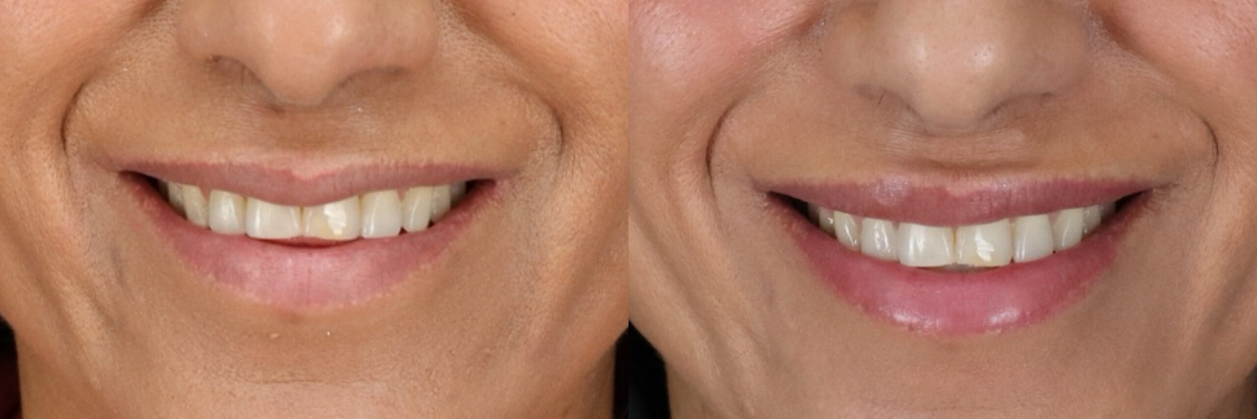 Before and after – Medi Spa – Female patient, age 50-59 – Image 8