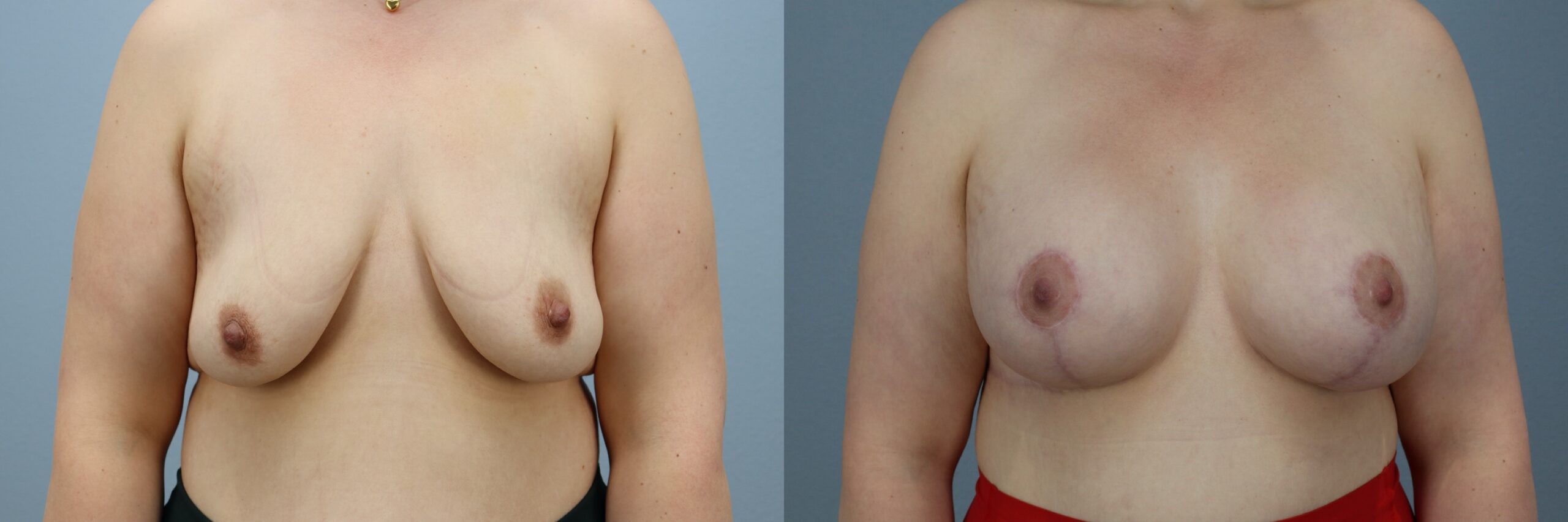 Before and after – Breast Surgery – Female patient, age 30-39 – Image 49