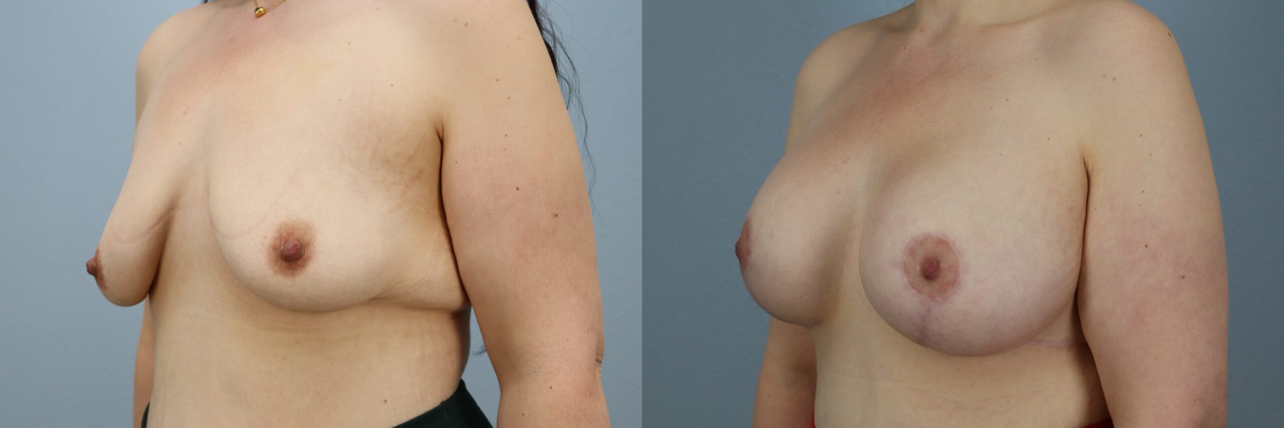 Before and after – Breast Surgery – Female patient, age 30-39 – Image 50