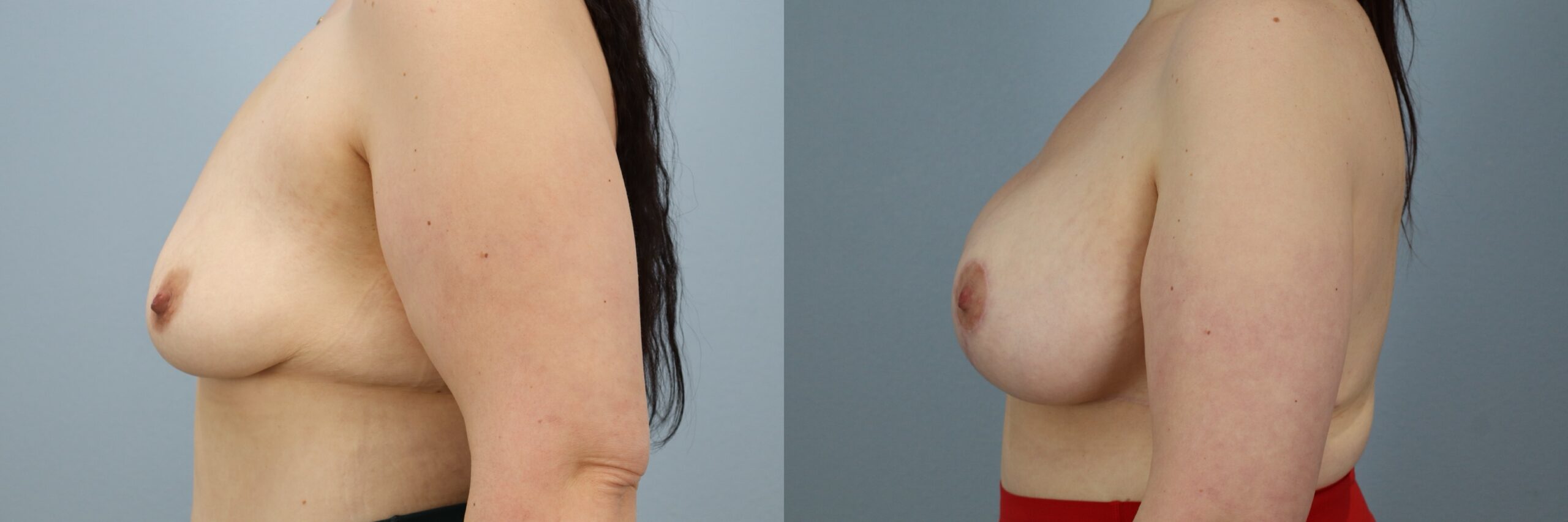 Before and after – Breast Surgery – Female patient, age 30-39 – Image 51