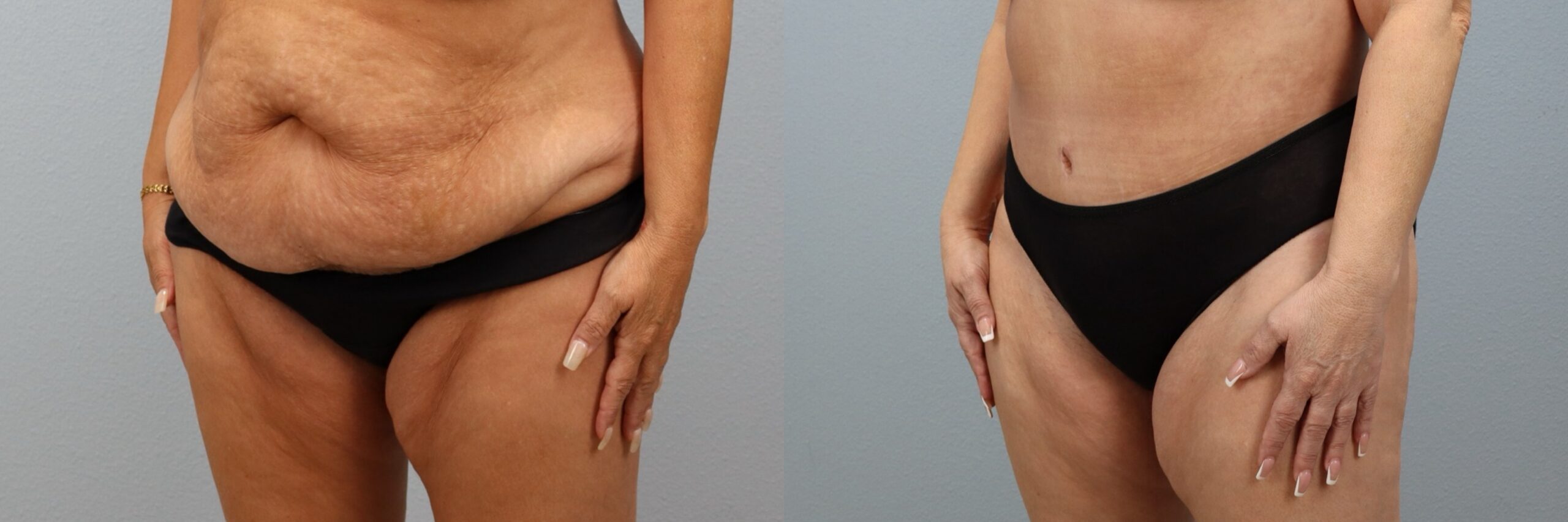 Before and after – Tummy Tuck – Female patient, age 50-59 – Image 47