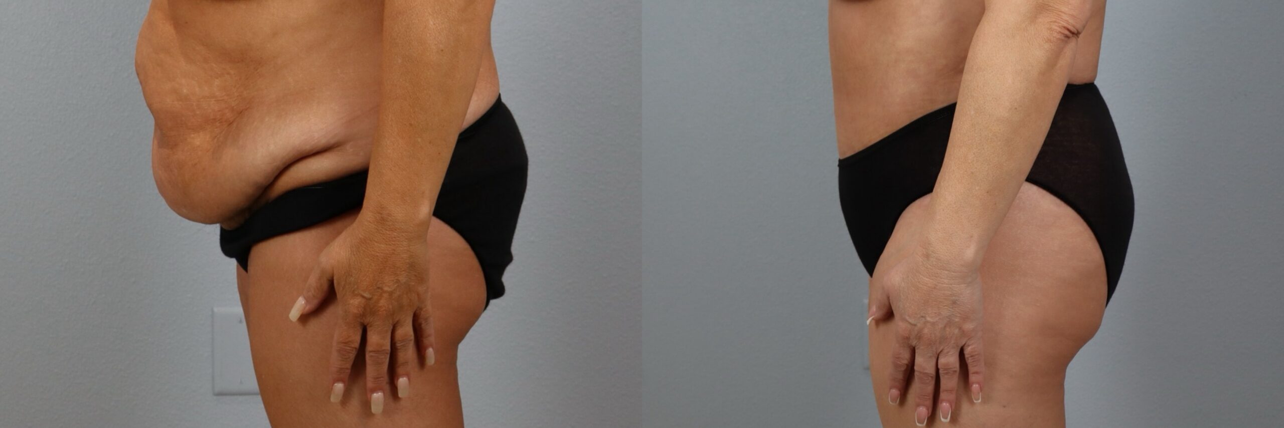 Before and after – Tummy Tuck – Female patient, age 50-59 – Image 48