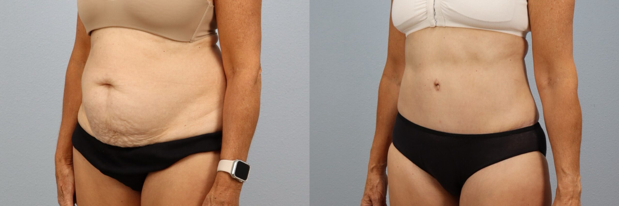 Before and after – Tummy Tuck – Female patient, age 60+ – Image 56