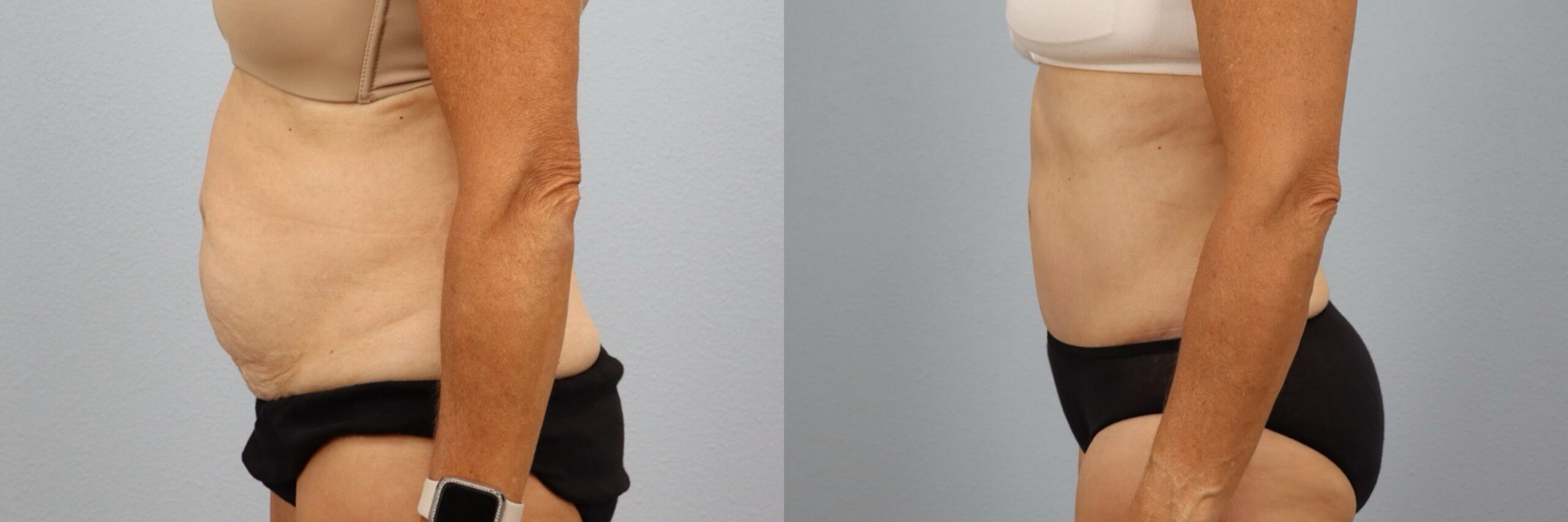 Before and after – Tummy Tuck – Female patient, age 60+ – Image 57