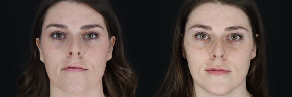 MW Botox Front Neutral