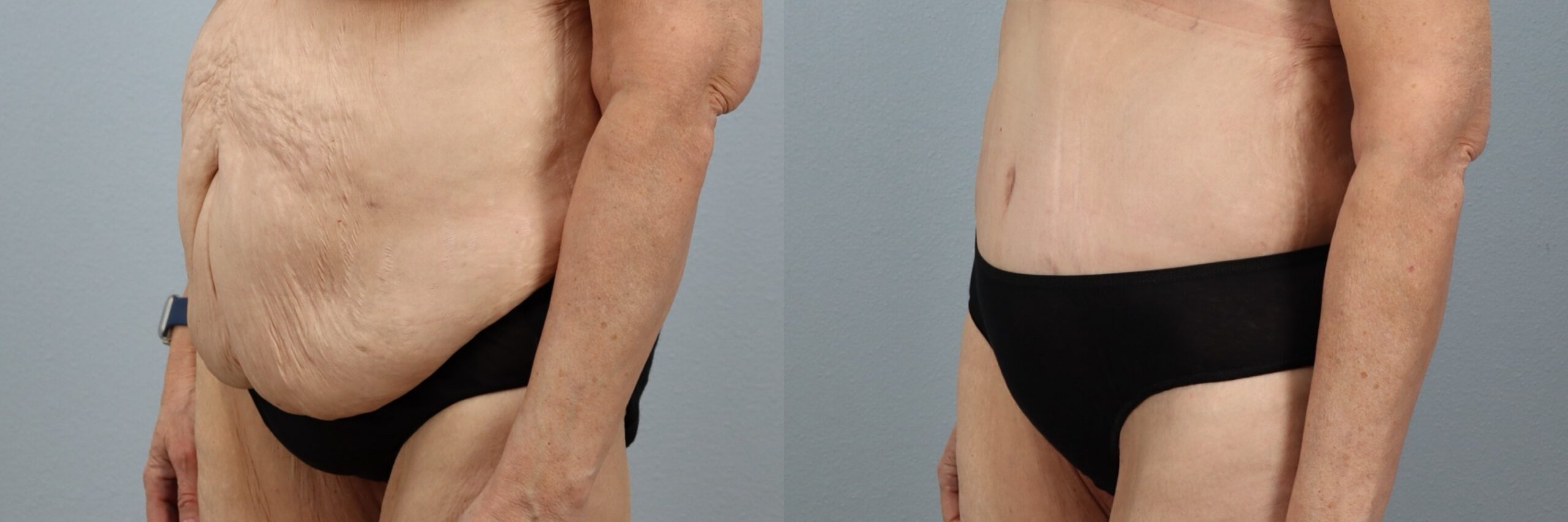 Before and after – Tummy Tuck – Female patient, age 60+ – Image 50